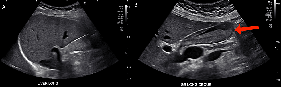 Cureus | Respiratory Syncytial Virus Associated Hepatitis in Pregnancy