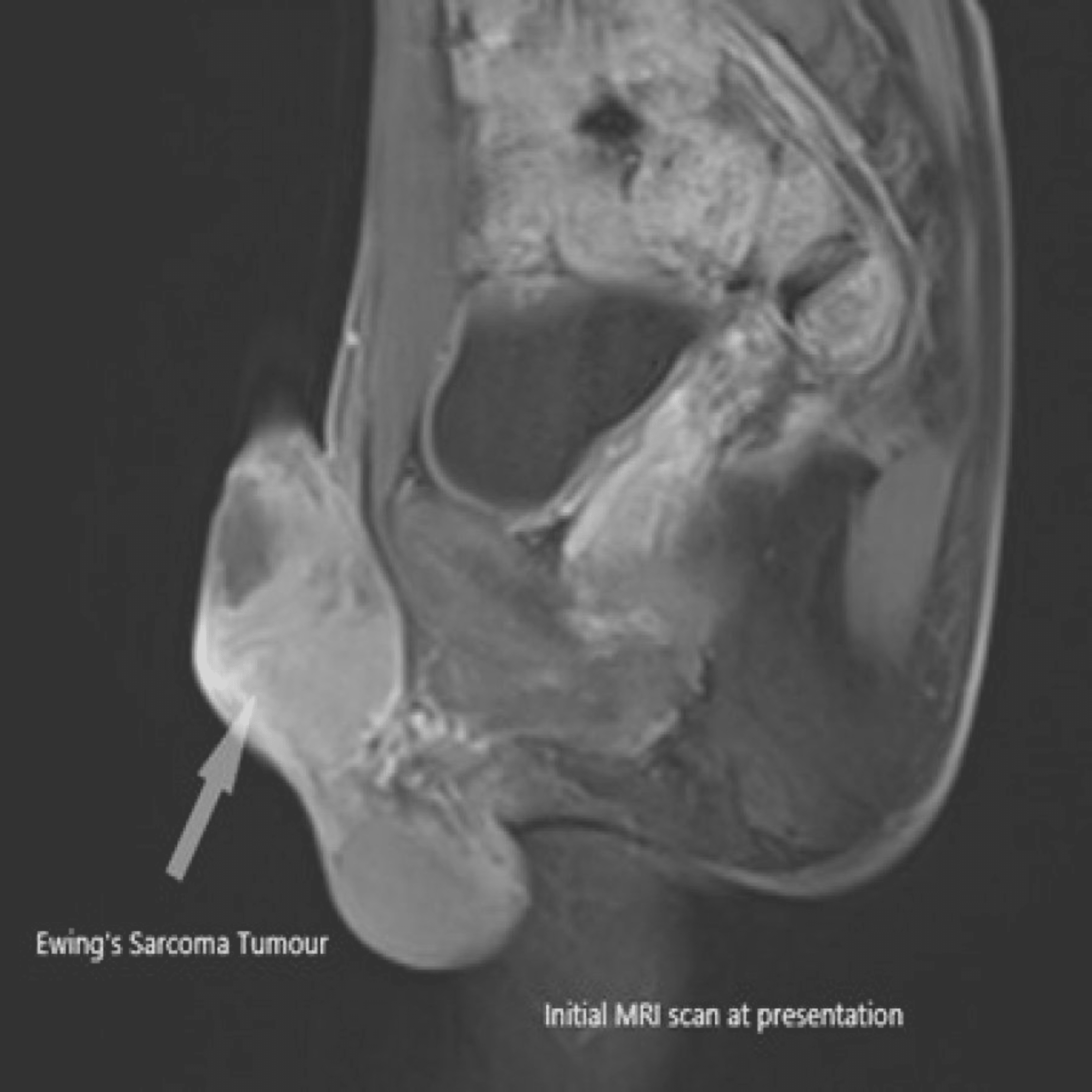 Cureus | Primary Ewing's Sarcoma of the Penis: First Reported Case in the  United Kingdom | Article