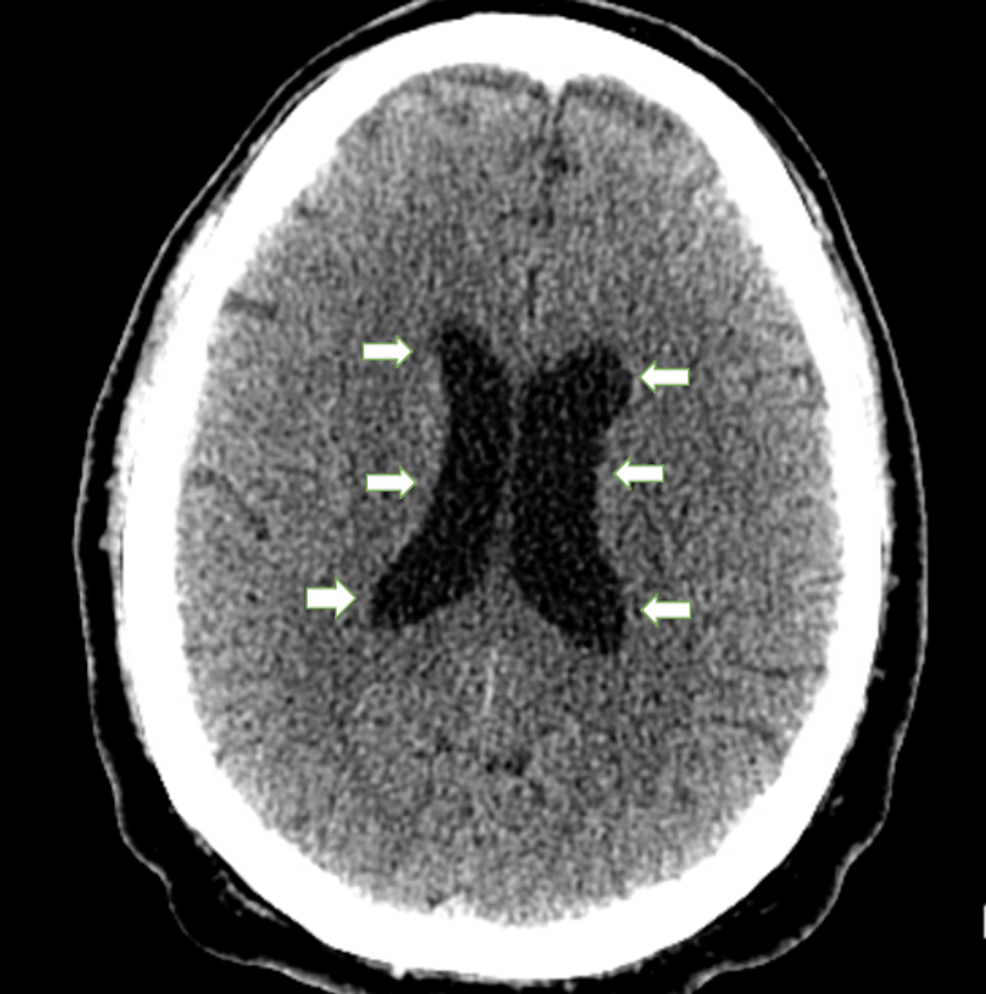 Head-CT-without-contrast