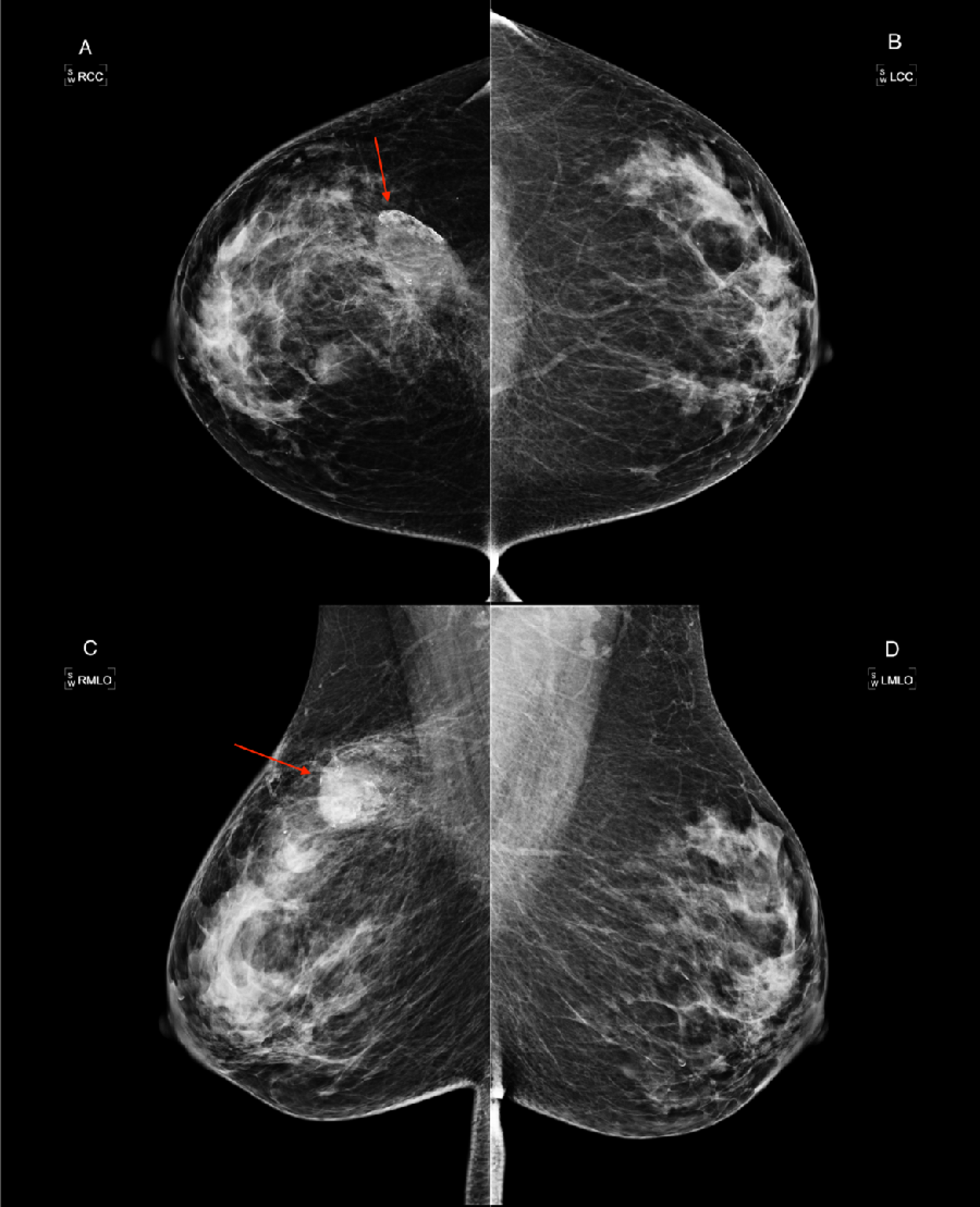 Upper outer quadrant of the right breast