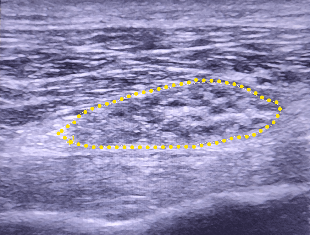 Short-axis view of the injured sciatic nerve (yellow dashed line) with cross-sectional area (CSA) measurement (1.50 cm2).