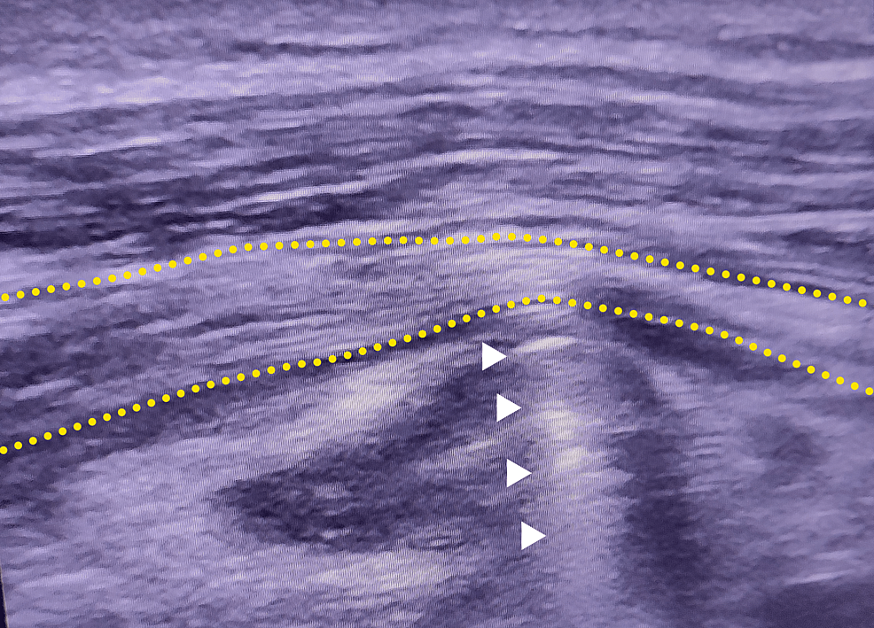 Long axis view of the injured sciatic nerve (yellow dashed lines) - showing significant swelling up to screw entrapment (white arrowheads).