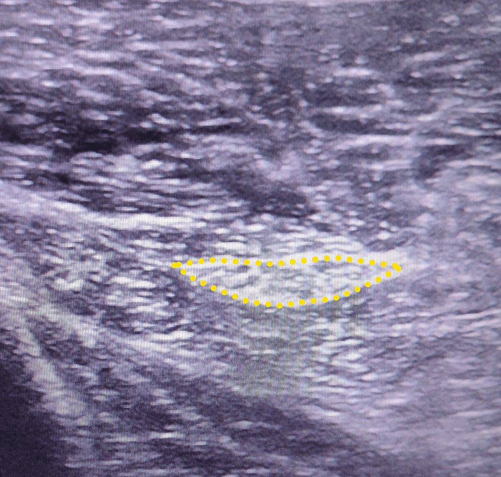 Normal-sciatic-nerve-(yellow-dotted-line)-of-contralateral-limb-with-cross-section-(CSA)-measurement-(0.33-cm2).