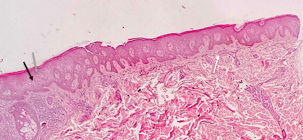 Prurigo Pigmentosa: A Case Report With Unusual Presentation | Cureus