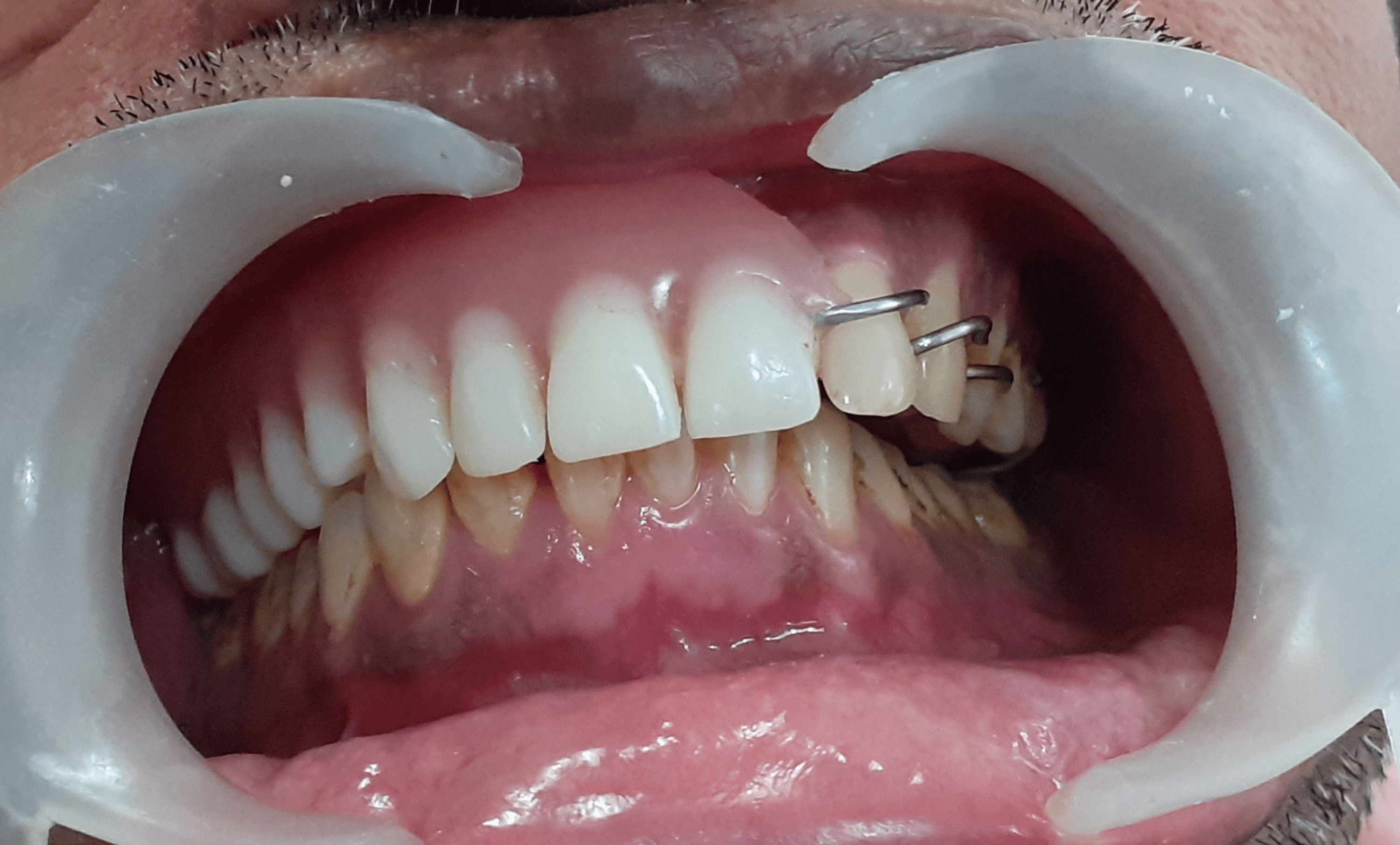 Maxillary Defect Rehabilitation Using A Hollow Bulb Obturator Cureus