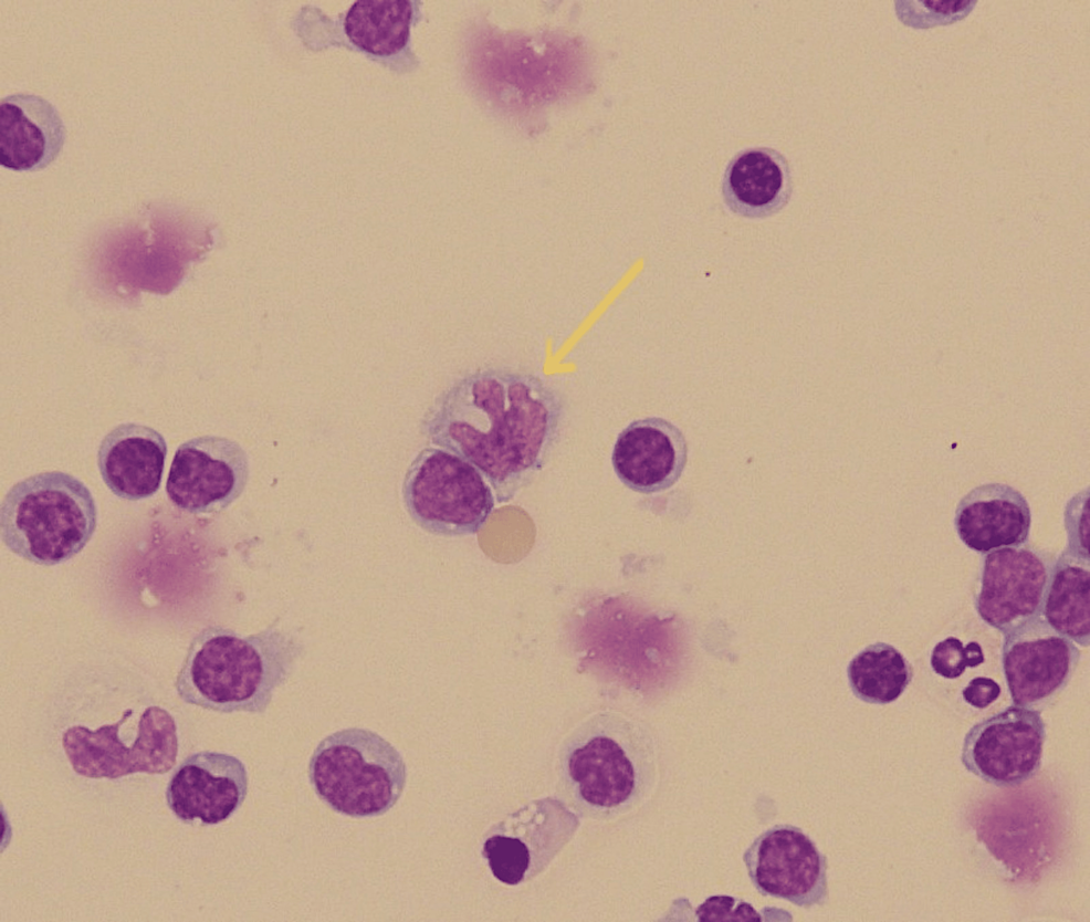 Giemsa-staining-showing-Mollaret's-cell-(indicated-by-the-yellow-arrow)
