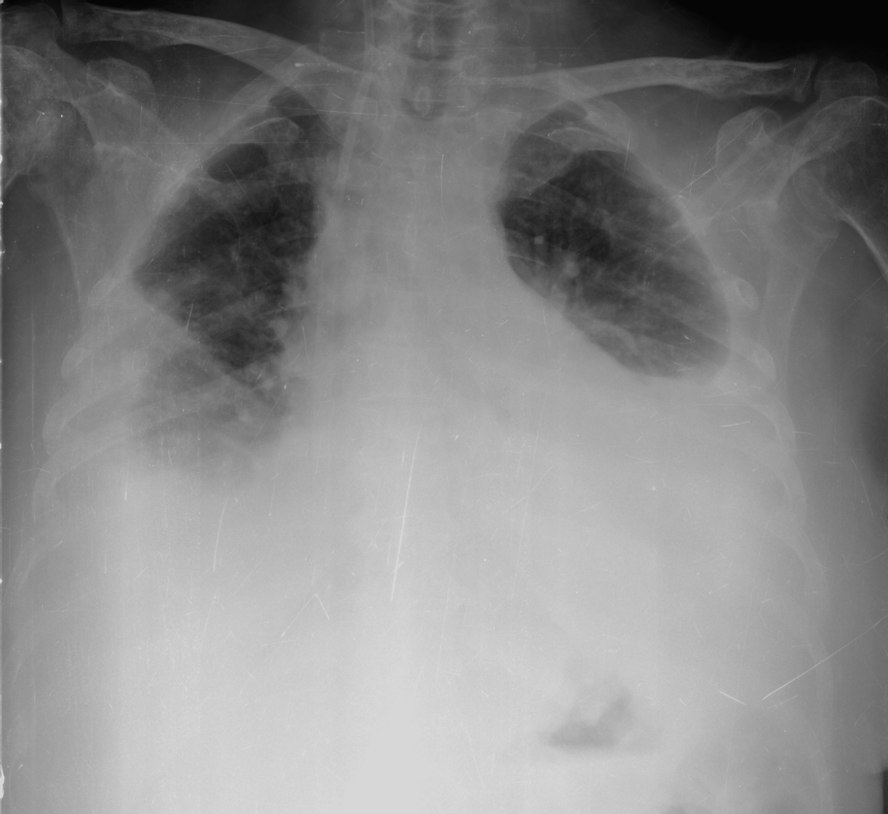 Cureus Upper Extremity Deep Vein Thrombosis as the Tip of the Iceberg