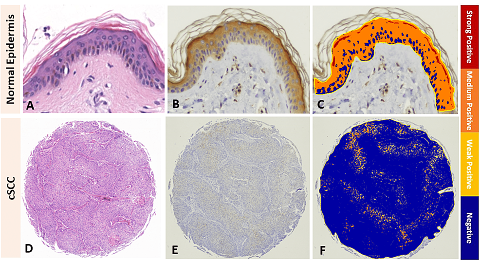 Cornulin-expression-in-normal-epidermis-versus-cutaneous-squamous-cell-carcinoma-tissue-samples.