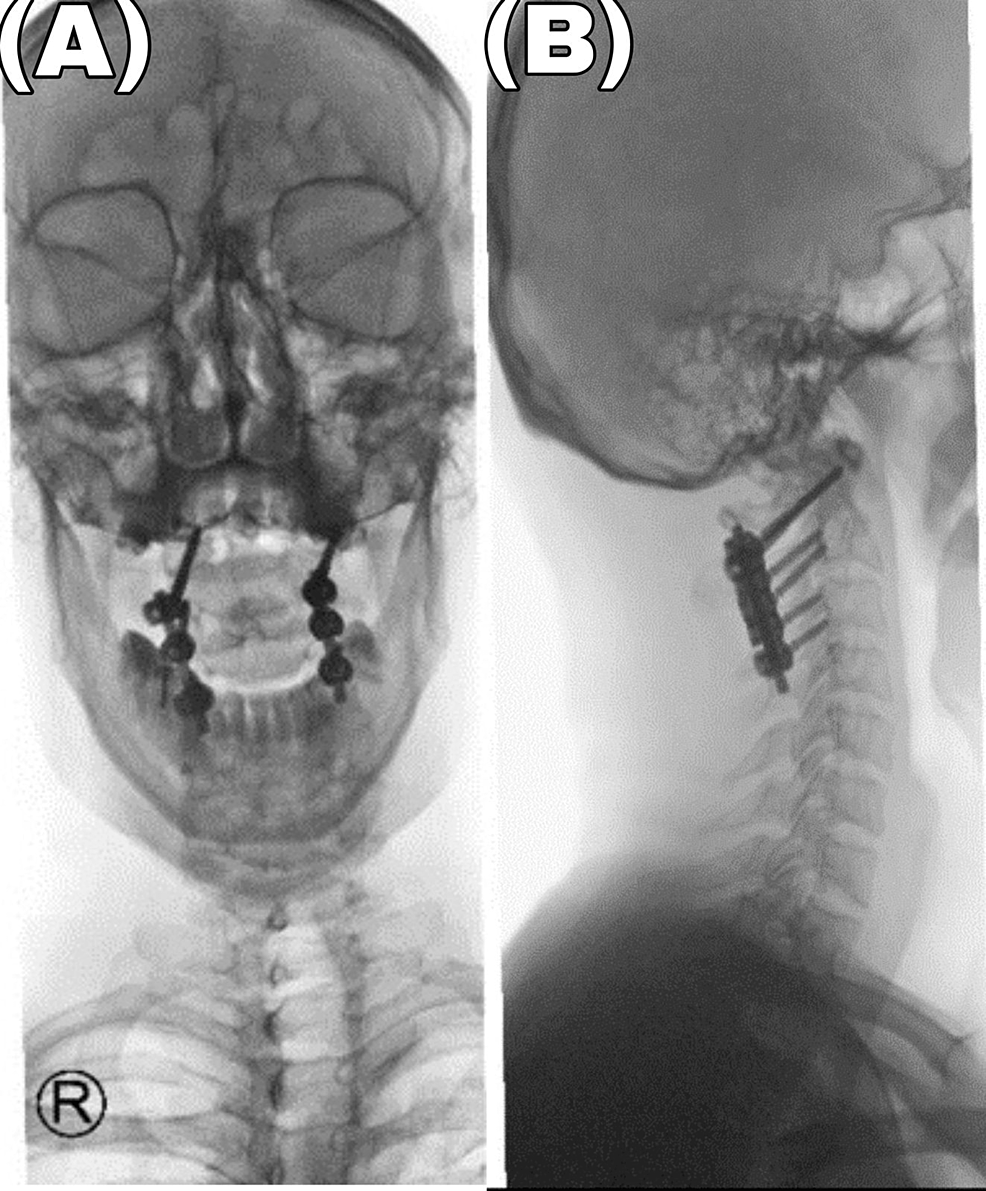 lateral-atlanto-axial-spinal-radiograph-during-definition-