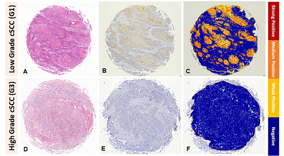 Cornulin-expression-in-low-histopathological-grade-cSCC-versus-high-histopathological-grade-cSCC-tissue-samples.