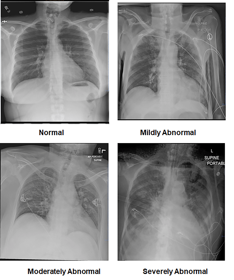 Cureus  COVID-19 vs. Influenza: A Chest X-ray Comparison