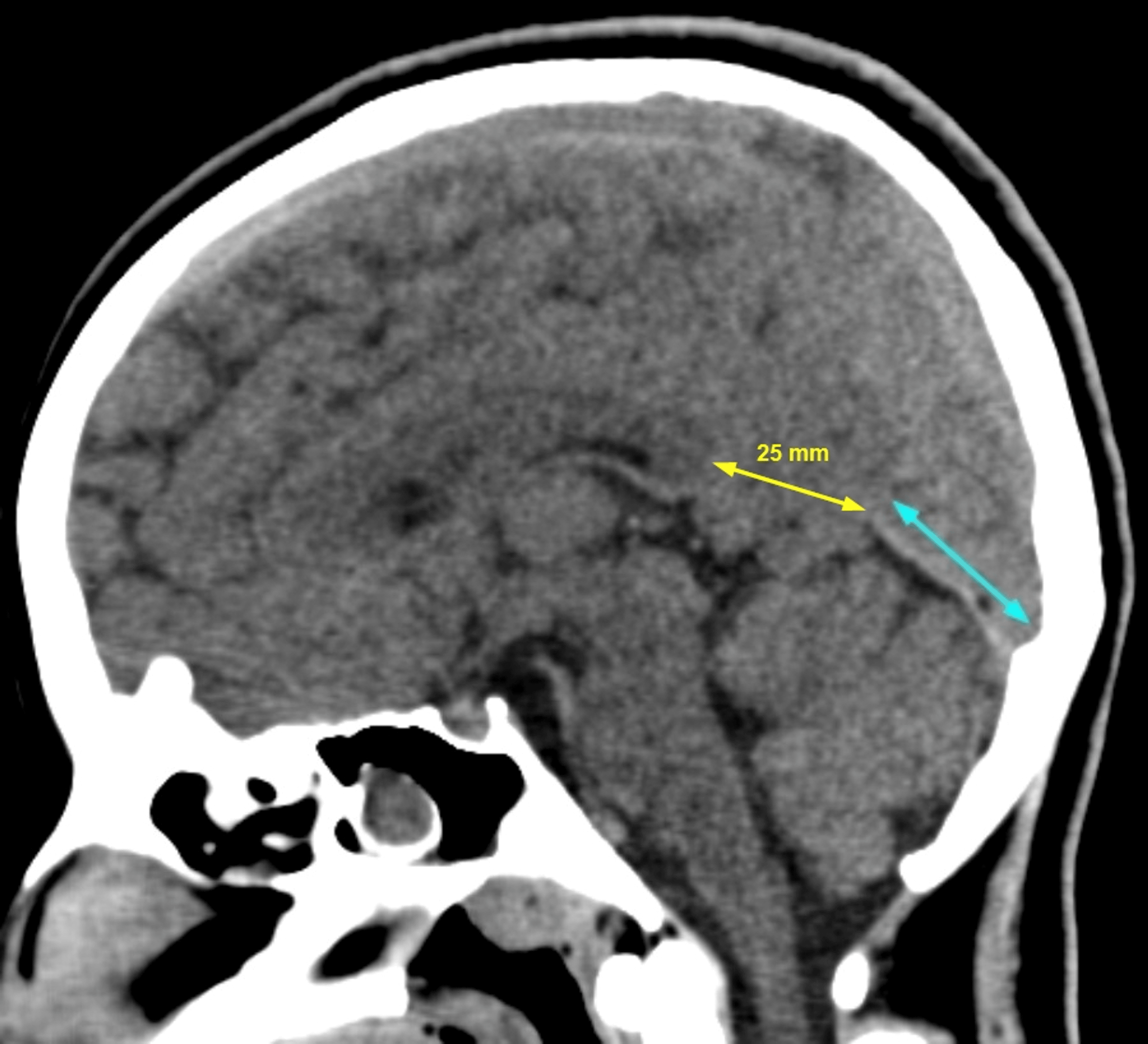 Cureus Bilateral Occipital Lobe Herniations Due to Asymmetric