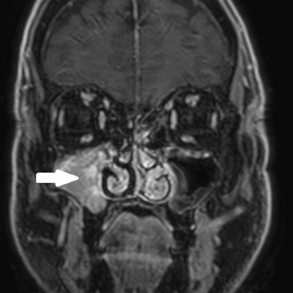 Preoperative-coronal-contrast-enhanced-MRI-T1-fat-saturated-image-on-the-level-of-the-maxillary-sinus-with-a-single-lesion-limited-to-the-inner--right-sinus,-Shokin-K Concomitant-and-slightly-contrasting-increase- (white arrow).