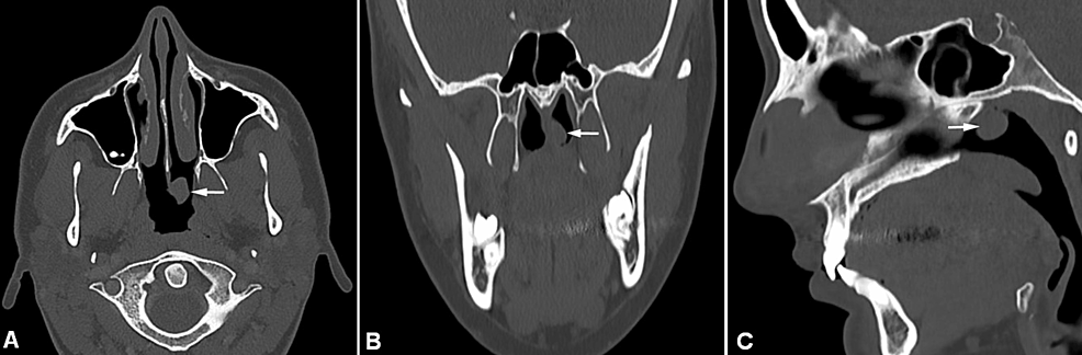 Cureus | An Extremely Rare Nasopharyngeal Malignant Tumor: A Case Report