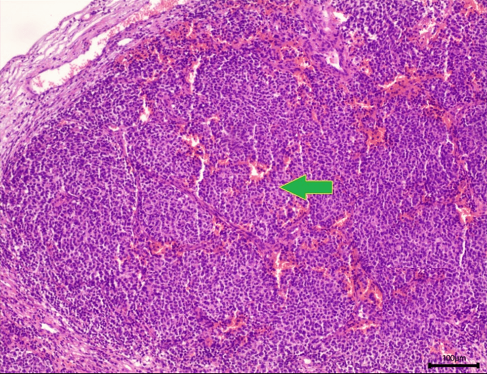Tumor-tissue-with-atypia-and-metaplasia-consistent with-Merkel-cell-carcinoma-(green-arrow).-magnification-40x