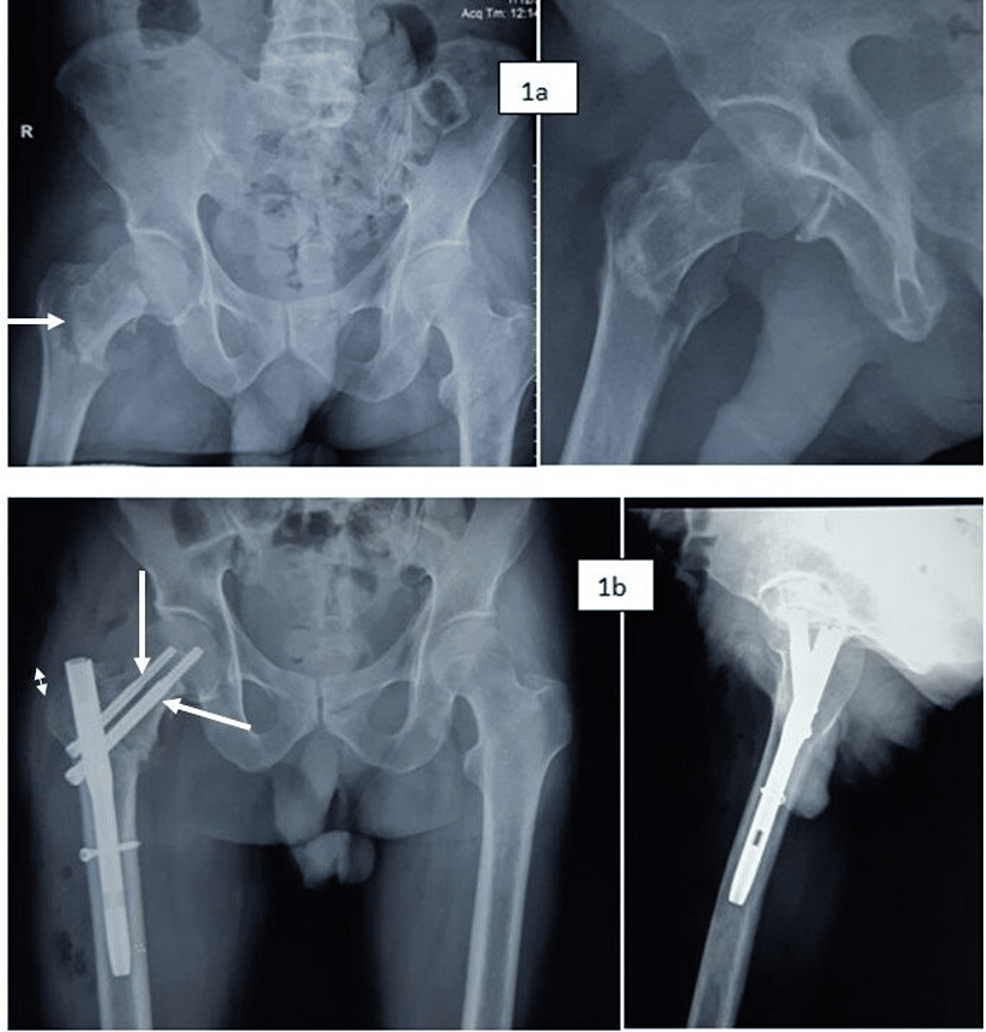 Treatment of Proximal Femur Fracture with a Newly Designed Nail:  Trochanteric Fixation Nail-Advanced (TFNA)