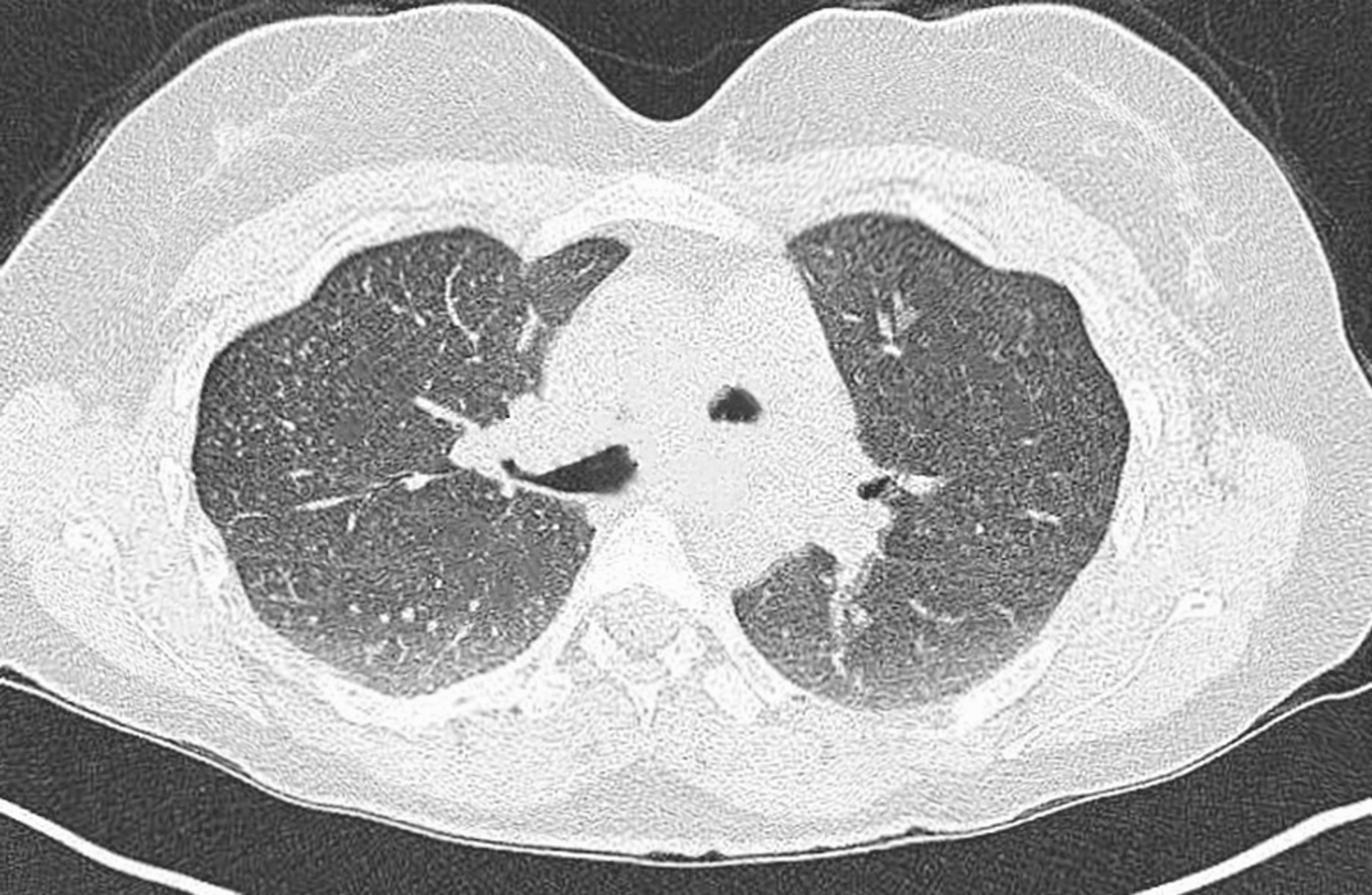 ANCA-Negative EGPA With Pulmonary, Cutaneous, and Neurological ...