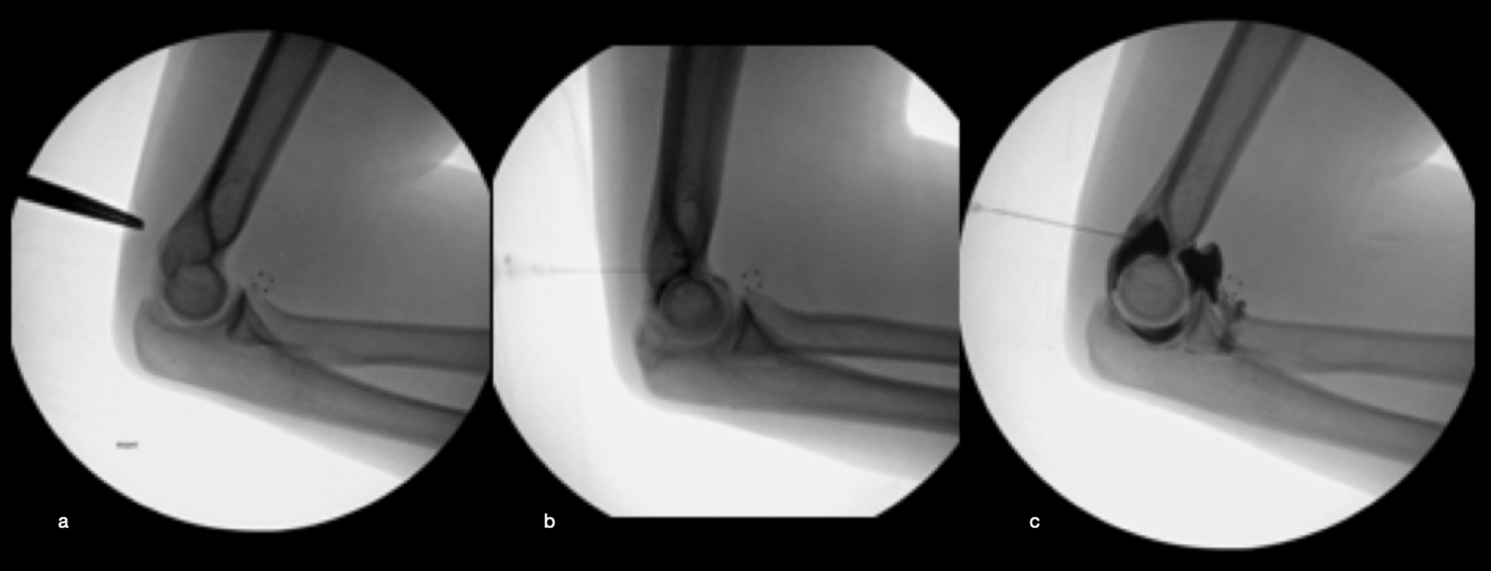 Cureus The Posterior Transtriceps Approach for Intraarticular Elbow