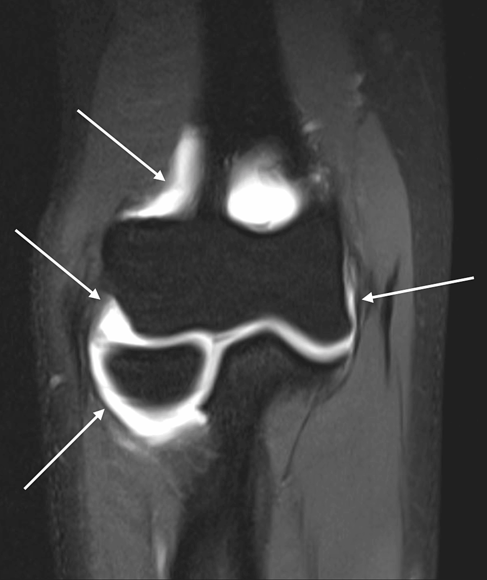 Cureus | The Posterior Transtriceps Approach for Intra-articular Elbow ...