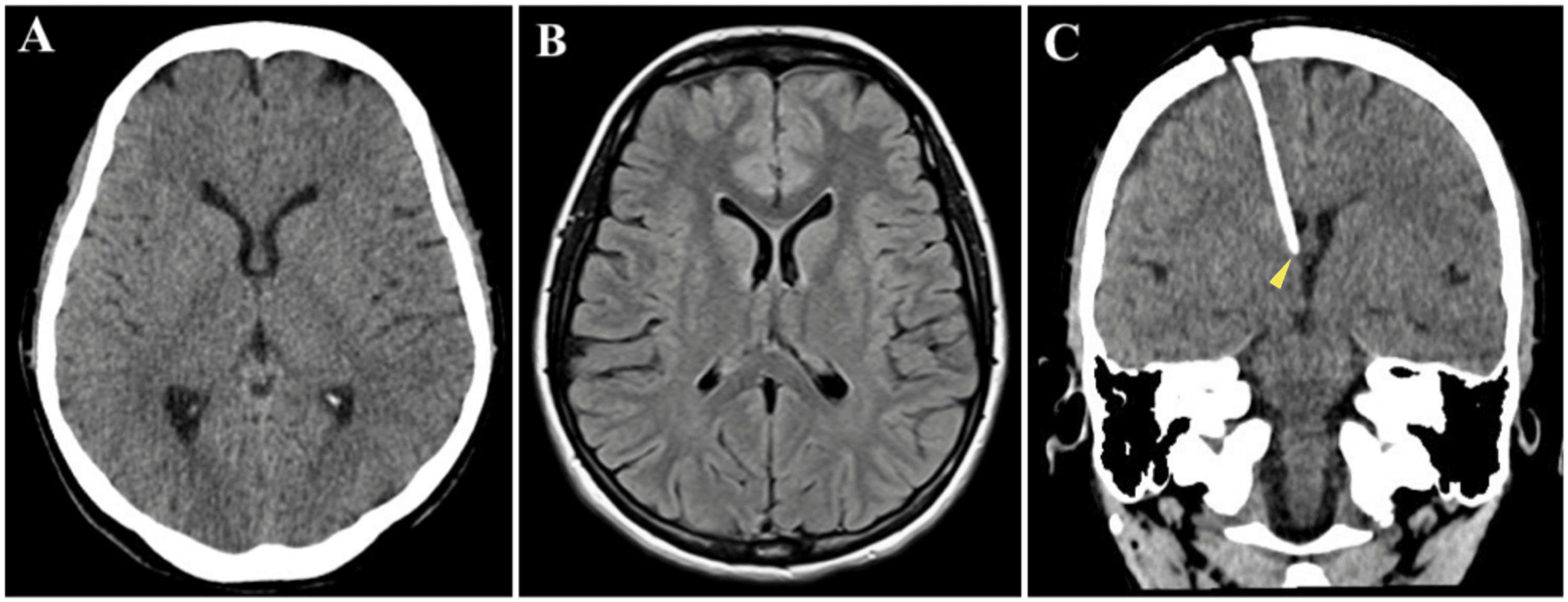 Freehand Ventriculoperitoneal Shunt for Idiopathic Intracranial