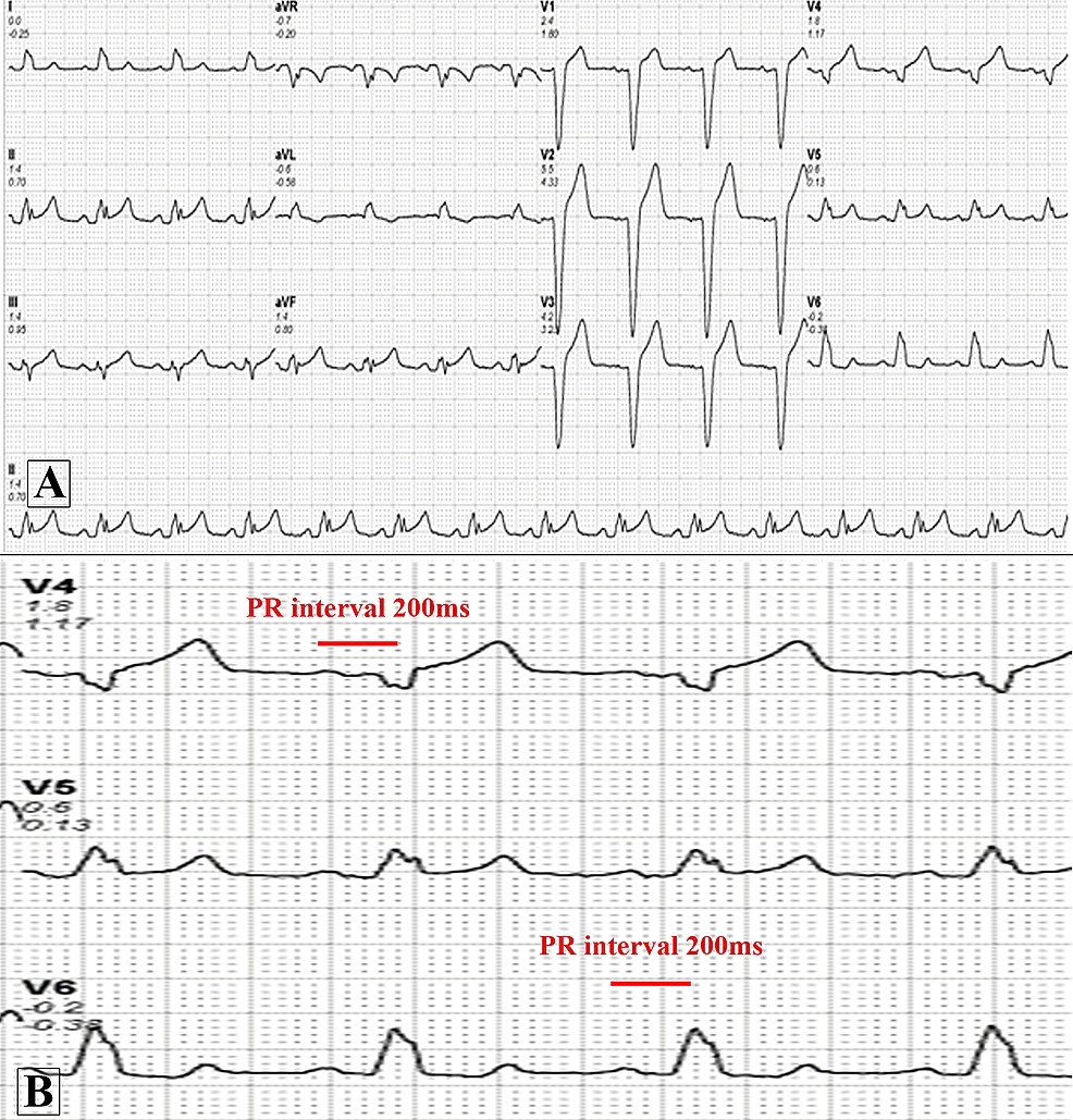 Cureus A Curious Case Of Intermittent Left Bundle Branch Block Associated With Cough