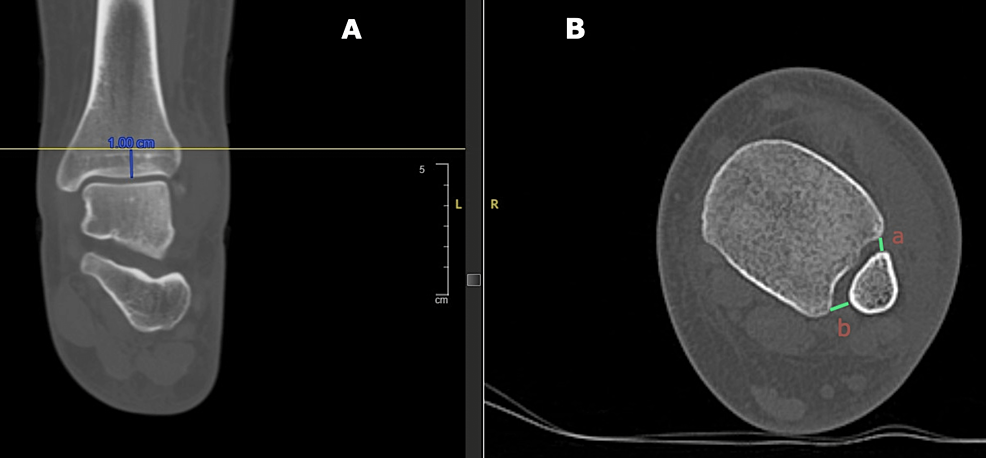 X-ray Image of Broken Heel. Stock Image - Image of calcaneus, doctor:  53838771