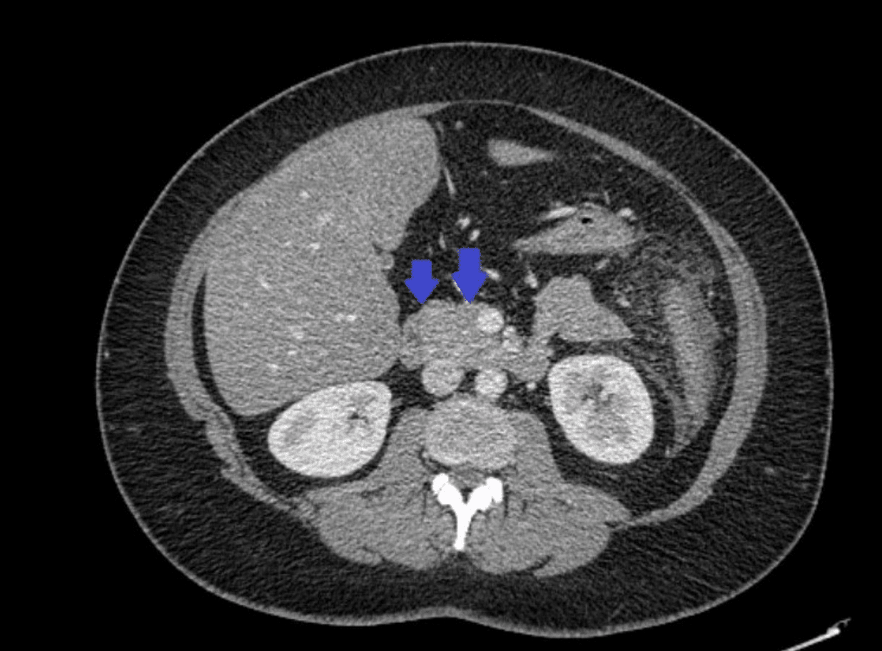 AzathioprineInduced Pancreatitis in a Patient With Systemic Lupus