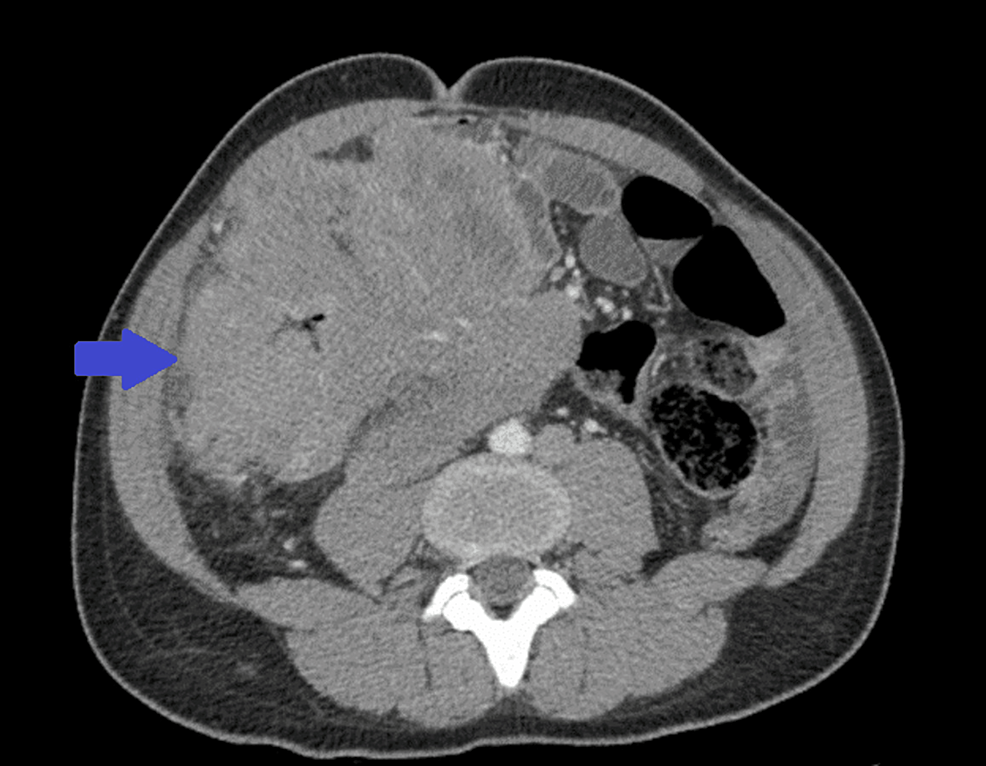 Diffuse Large B-cell Lymphoma in a Young Patient Presenting as a Cecal ...