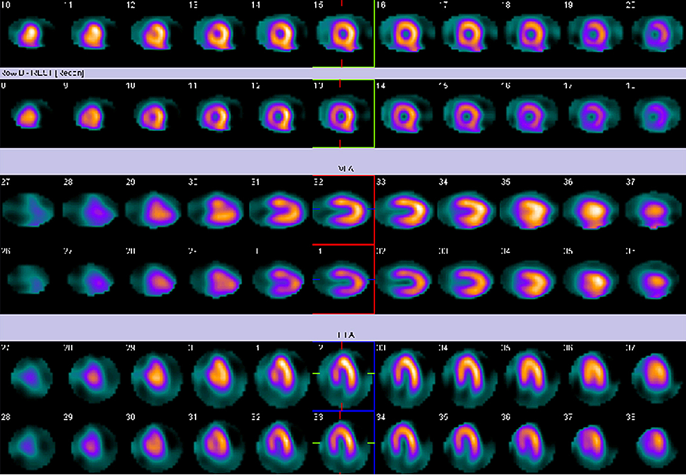 Cureus | A Curious Case of Intermittent Left Bundle Branch Block ...