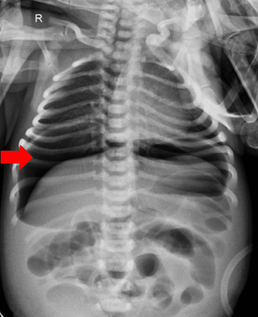 Spontaneous Intestinal Perforation In Neonates Involving The Cecum A Case Report Cureus