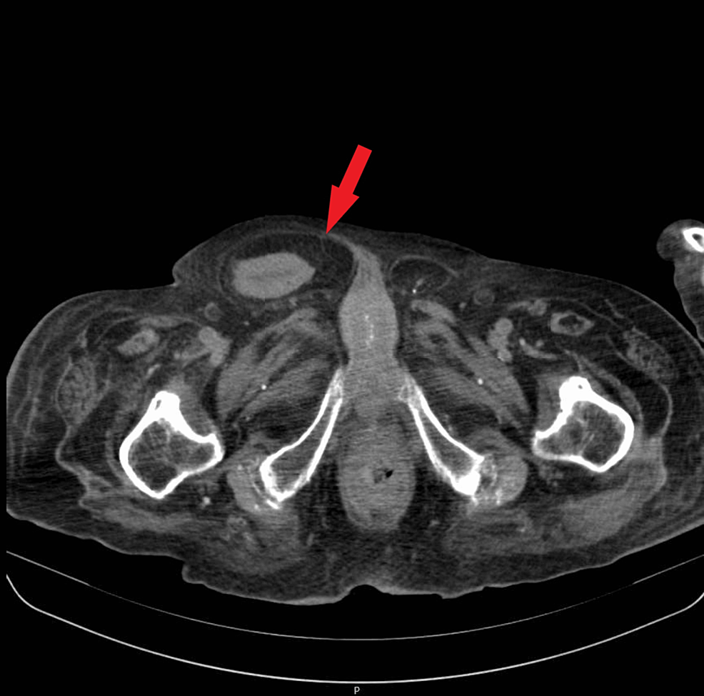 cureus-a-rare-image-of-bladder-herniation-concealed-in-a-frequent