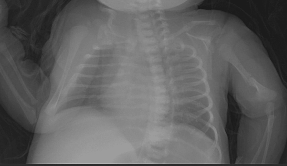 X-ray showing bilateral clavicle fracture and left humerus fracture
