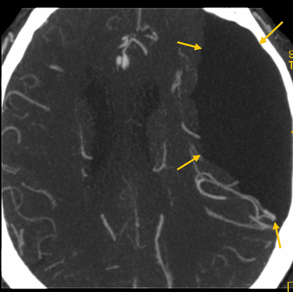 Brain-computed-tomography-with-angiography