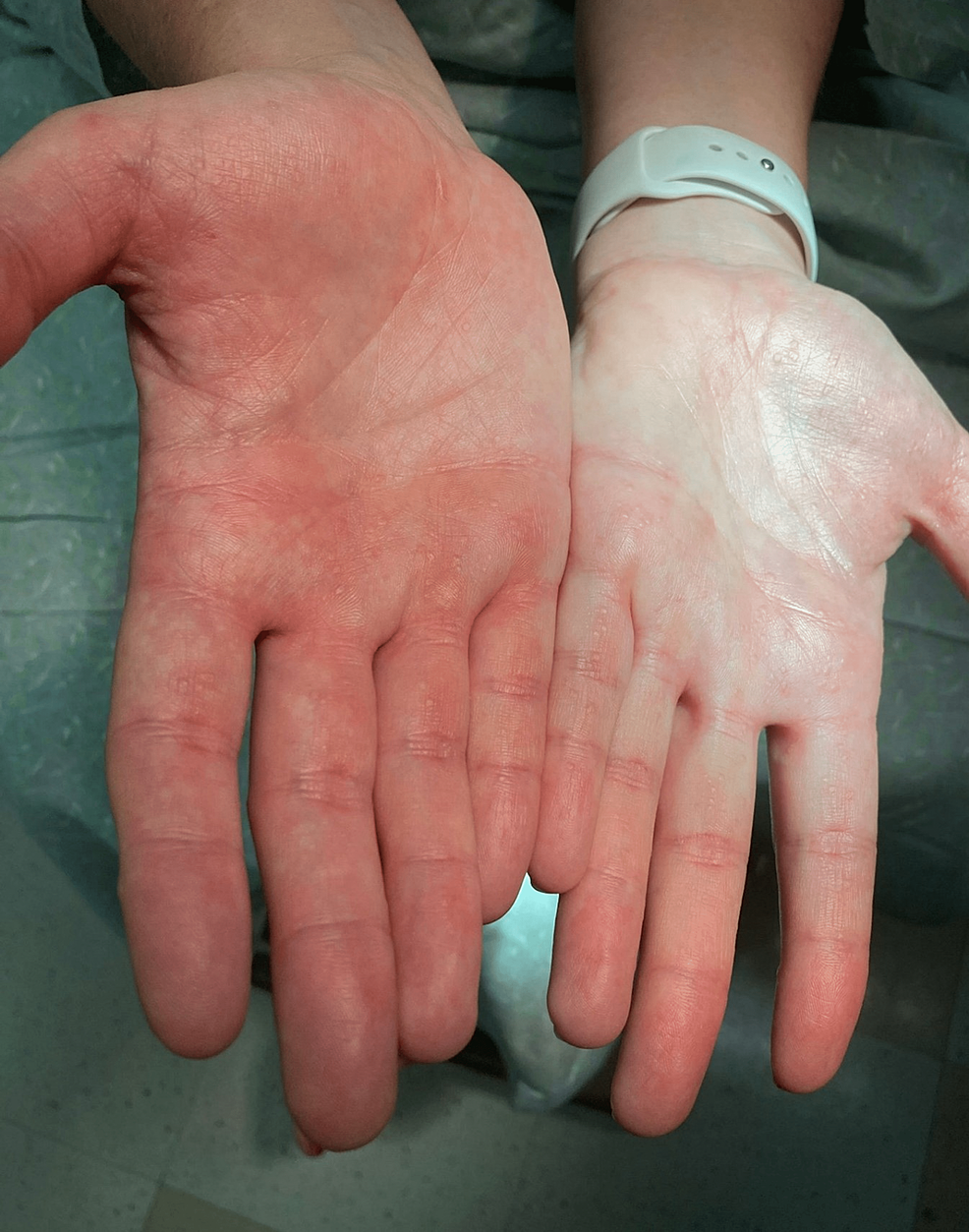 palm-surface-of-the-patient-display-multiple-dots-hyperkeratosis-papules-on-the-palm-and-fingers