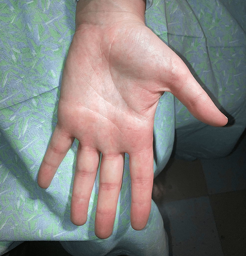 palm-surface-left-hand-appears-multipoint-hyperkeratotic-papules-on-the-palm-and-fingers