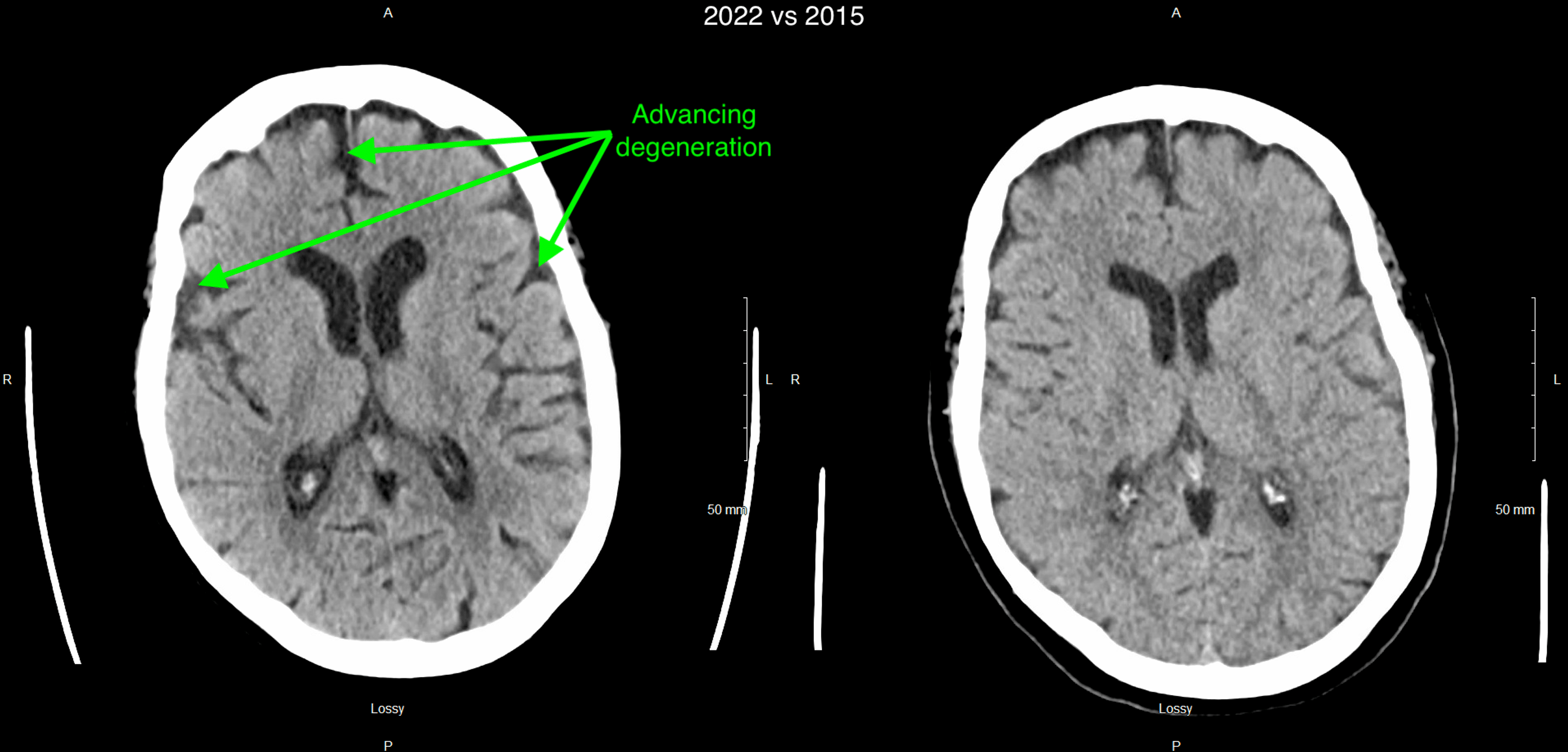 Rapidly Progressive Frontotemporal Dementia With Amyotrophic Lateral Sclerosis In An Elderly