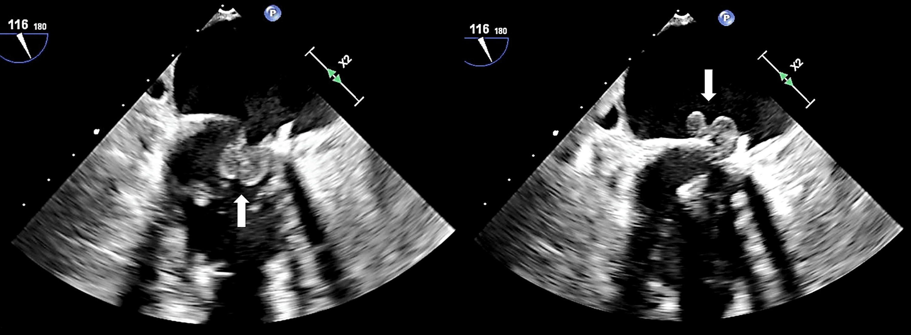 Cureus Prosthetic Valve Infective Endocarditis Secondary to Neisseria