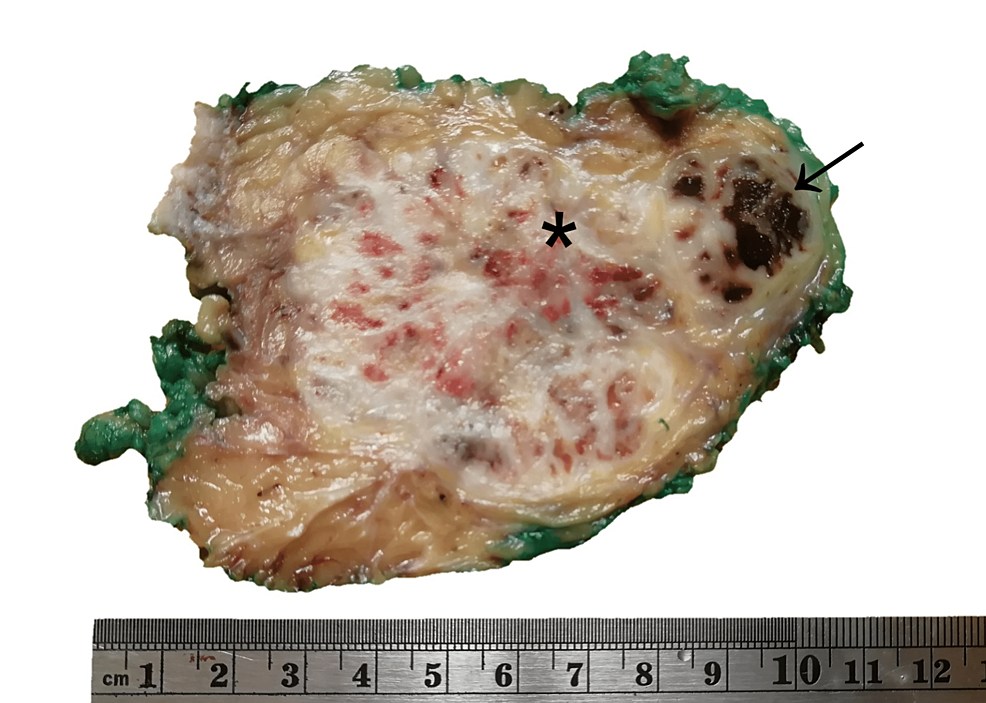 Excision-of-abdominal-wall-tumor-measuring-10-x-8.5-x-7-cm,-with-a-yellowish,-multilobular-cut-surface-with-cystic-areas-with-a-necrotic-(black-arrow)-and-hemorrhagic-(asterisk)-appearance.