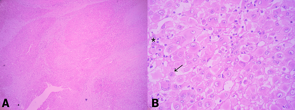 Hematoxylin-and-eosin-(H&amp;E)-staining.-(A)-H&amp;E-x-40:-infiltrative-pattern-with-the-formation-of-large-oval-nodules.-(B)-H&amp;E-x-400:&nbsp;large,-polygonal-cells-with-defined-borders,-with-dense-eosinophilic-cytoplasm-and-epithelial-appearance.-The-nuclei-are-large,-vesicular,-with-prominent-nucleoli-(black-arrow).-Some-cells-have-a-rhabdoid-appearance-and-others-are-multinucleated-(asterisk).