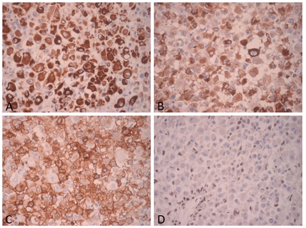 Neoplastic-cells-show-immunoexpression-for-(A)-PANCK---AE1/AE3,-(B)-EMA,-(C)-CD34,-and-(D)-loss-of-nuclear-expression-in-malignant-cells-for-INI1.