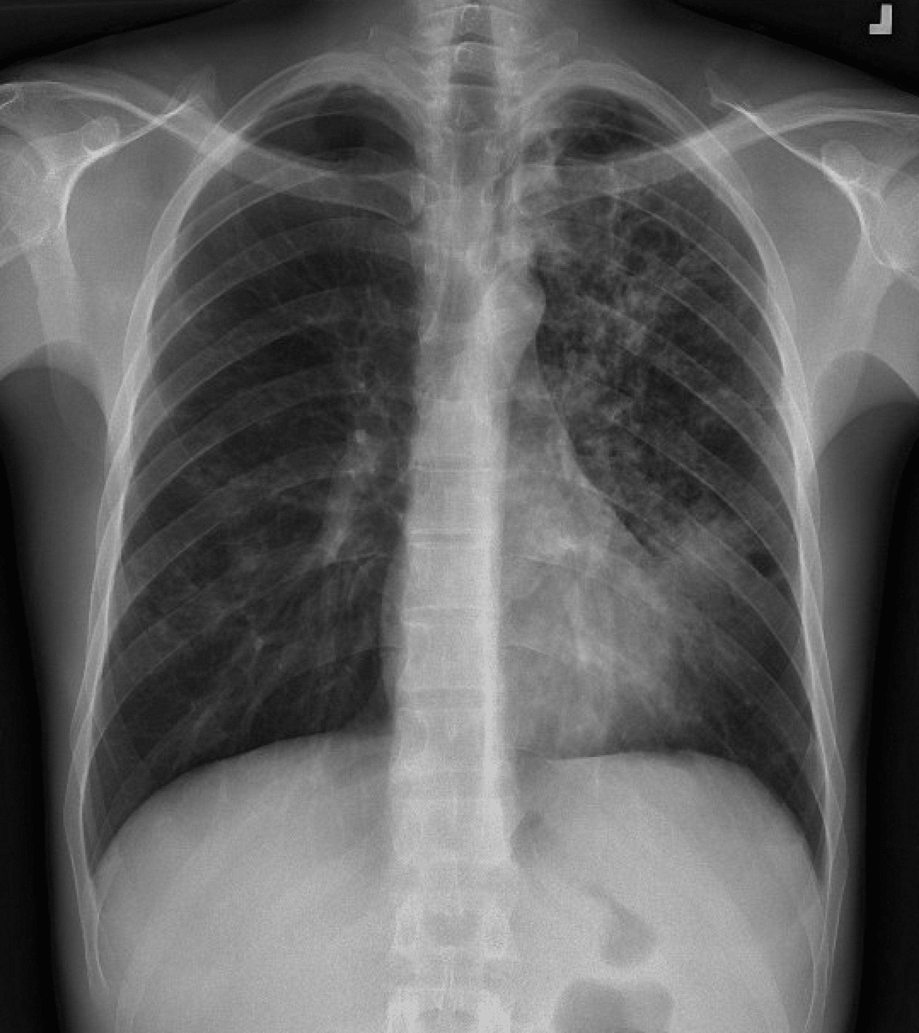 Cureus A Case of MultidrugResistant (MDR) Tuberculosis and HIV Co