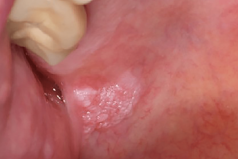 squamous papilloma on gingiva