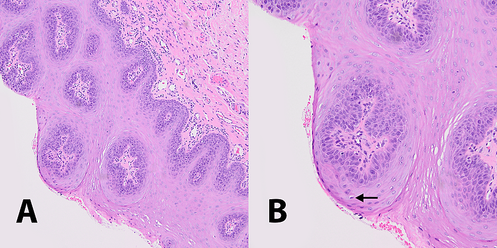 Cureus Oral Squamous Papilloma Mimicking Oral Verrucous Leukoplakia