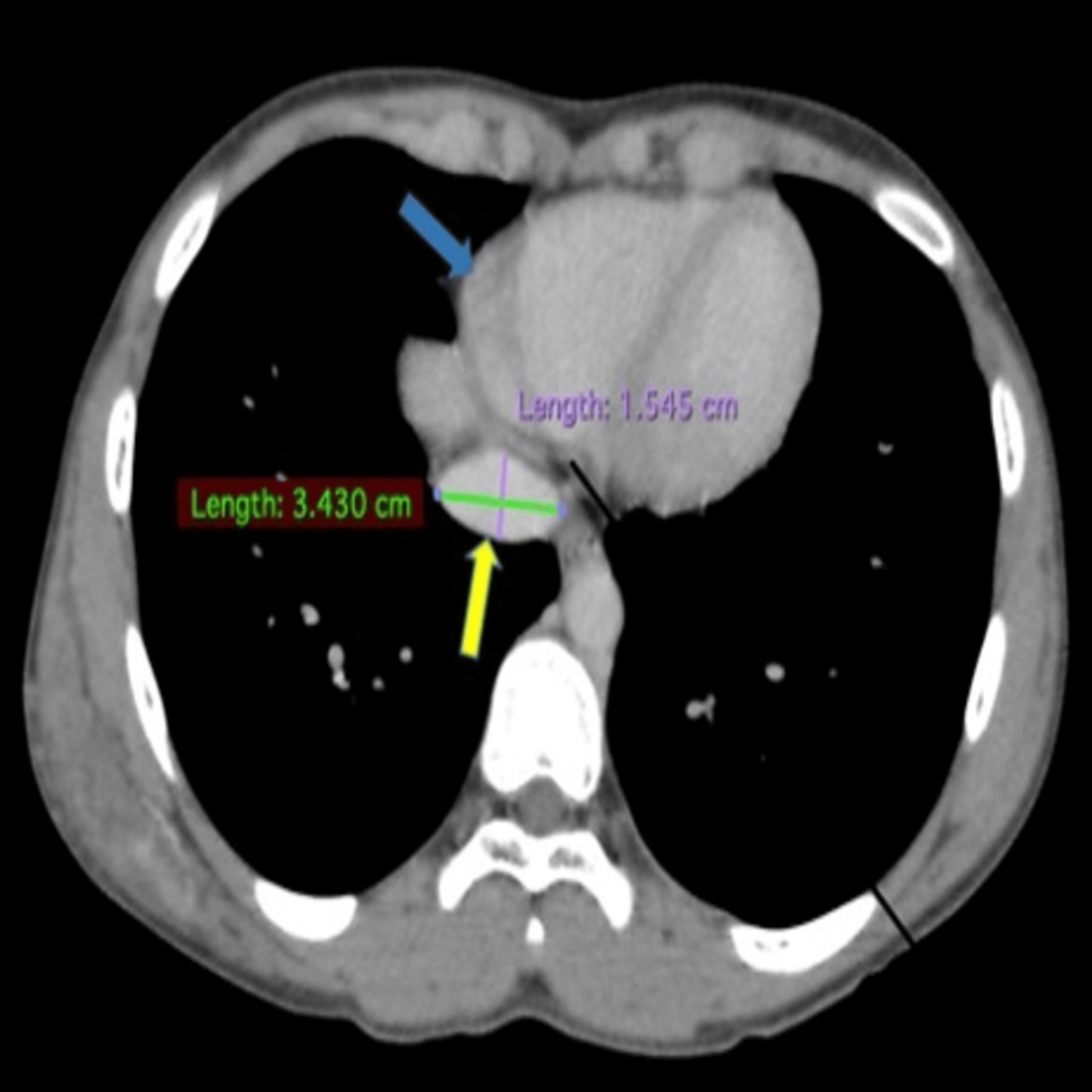 Evaluation of Normal Inferior Vena Cava Diameters in the Indian Adult