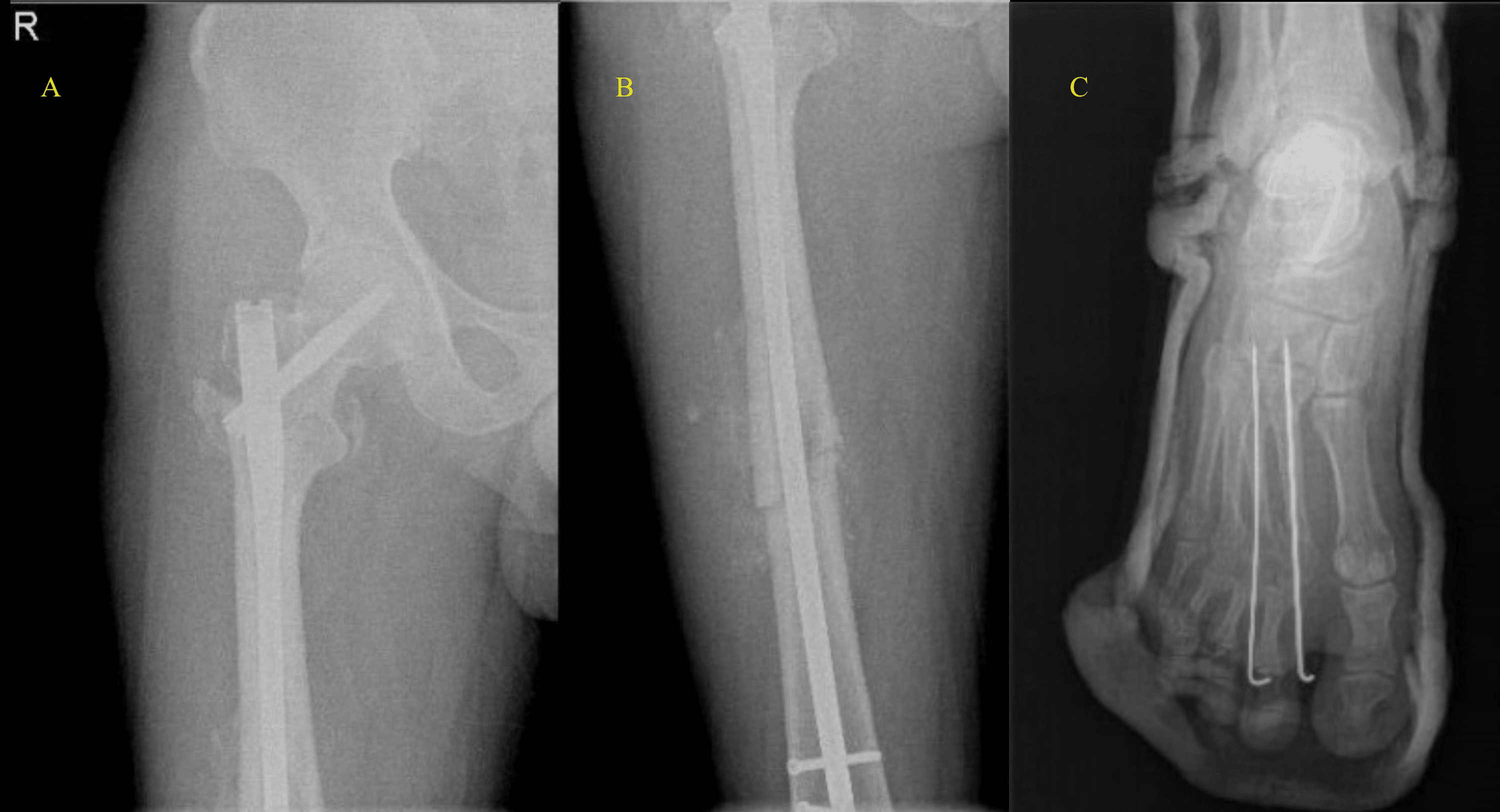 Cureus Ipsilateral Intertrochanteric and Femoral Shaft Fractures Associated With