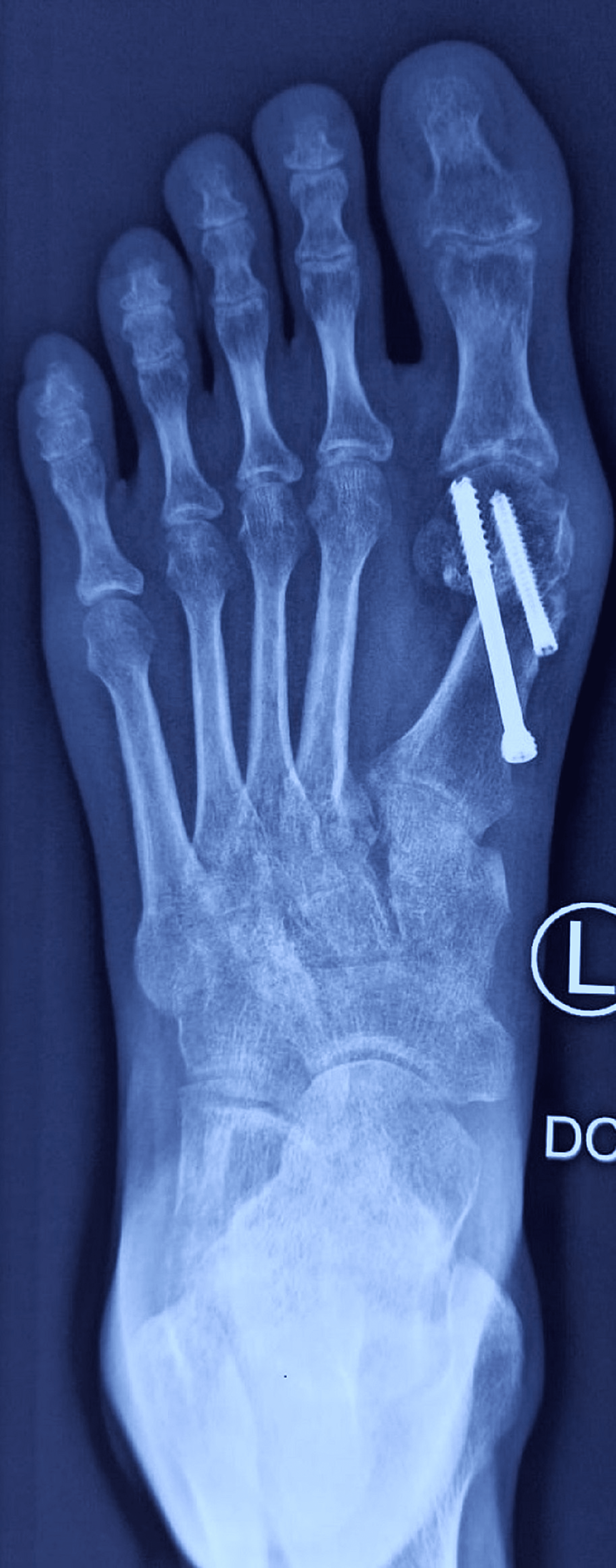 Cureus A Minimally Invasive Surgical Technique For Hallux Valgus Deformity Correction Using An