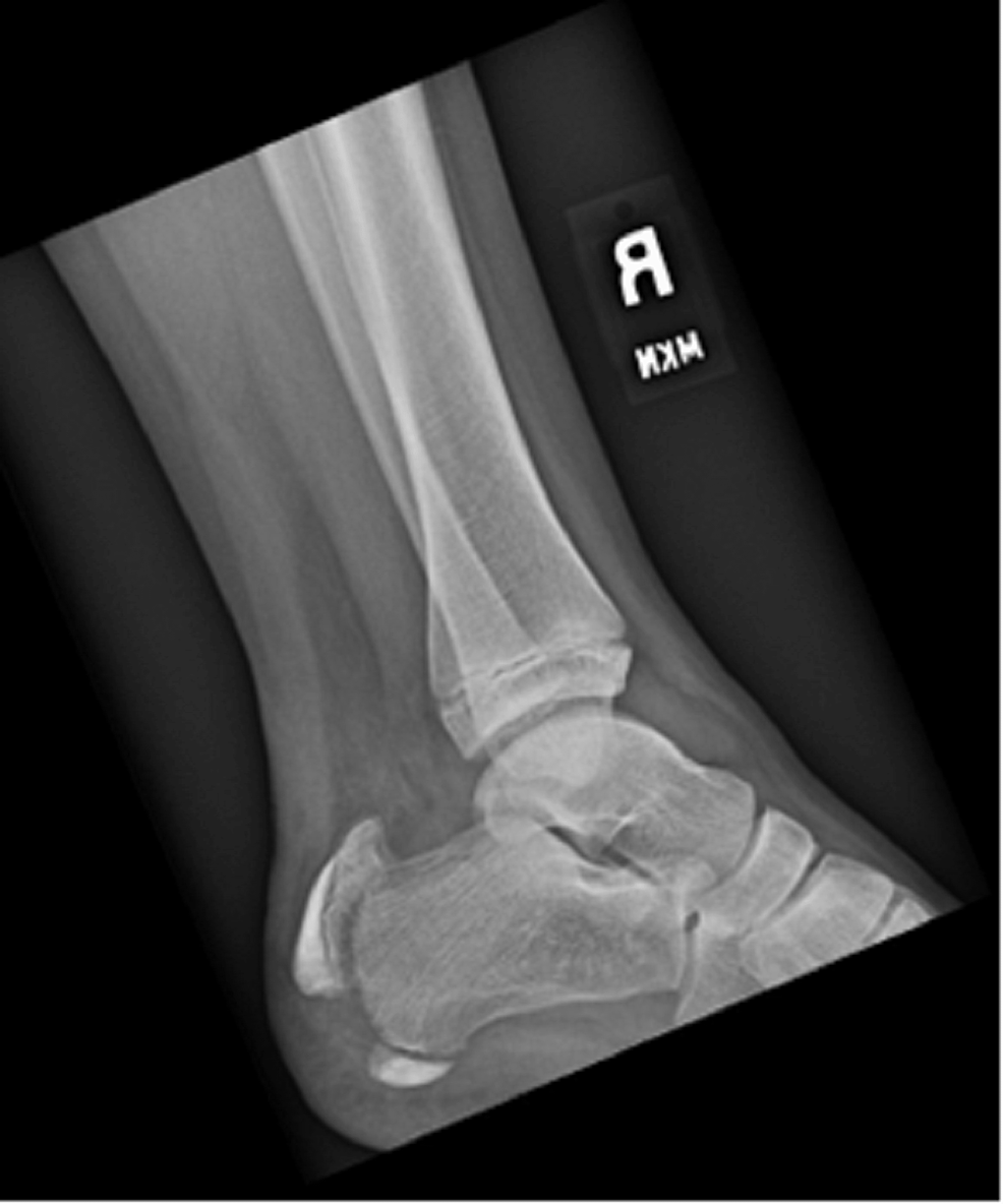 Treatment of the Accessory Navicular