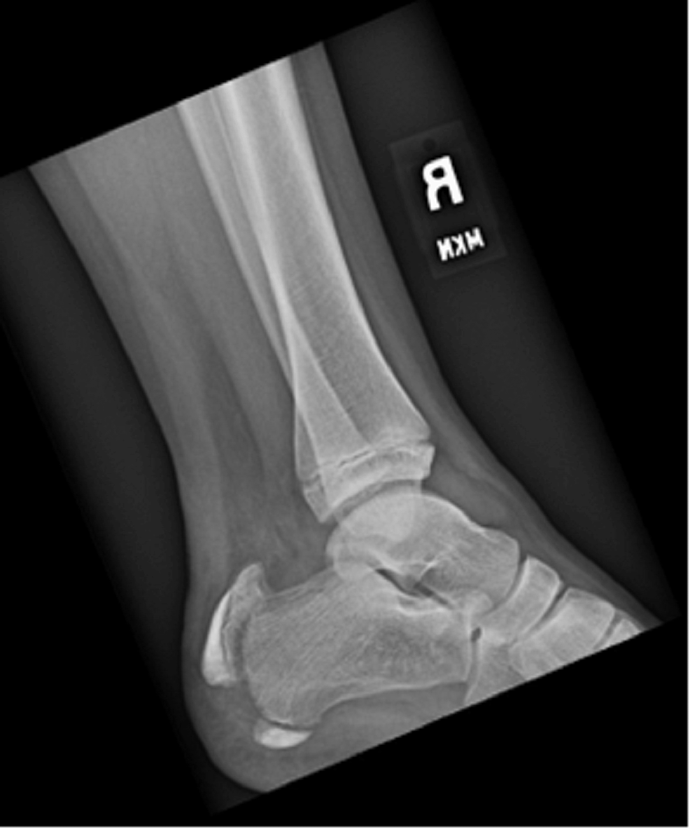 Open Reduction And Internal Fixation Of A Pediatric Apophyseal 
