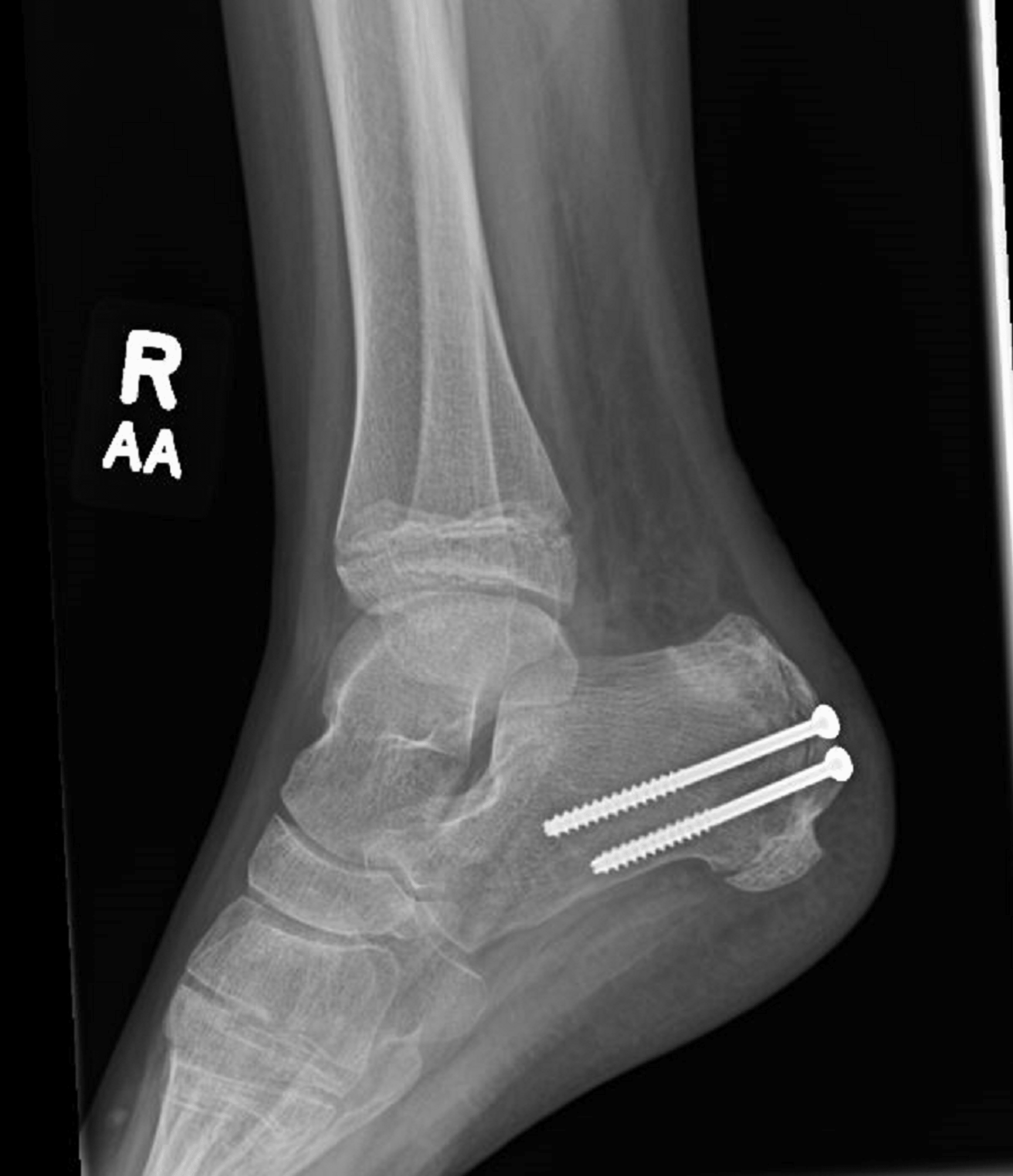 Open Reduction and Internal Fixation of a Pediatric Apophyseal