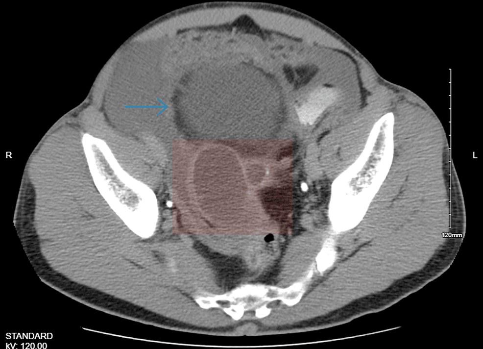 Rare Mucinous Adenocarcinoma Of The Appendix Undergoing Multiple ...